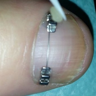 fix resine