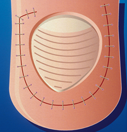 Ongle incarné
